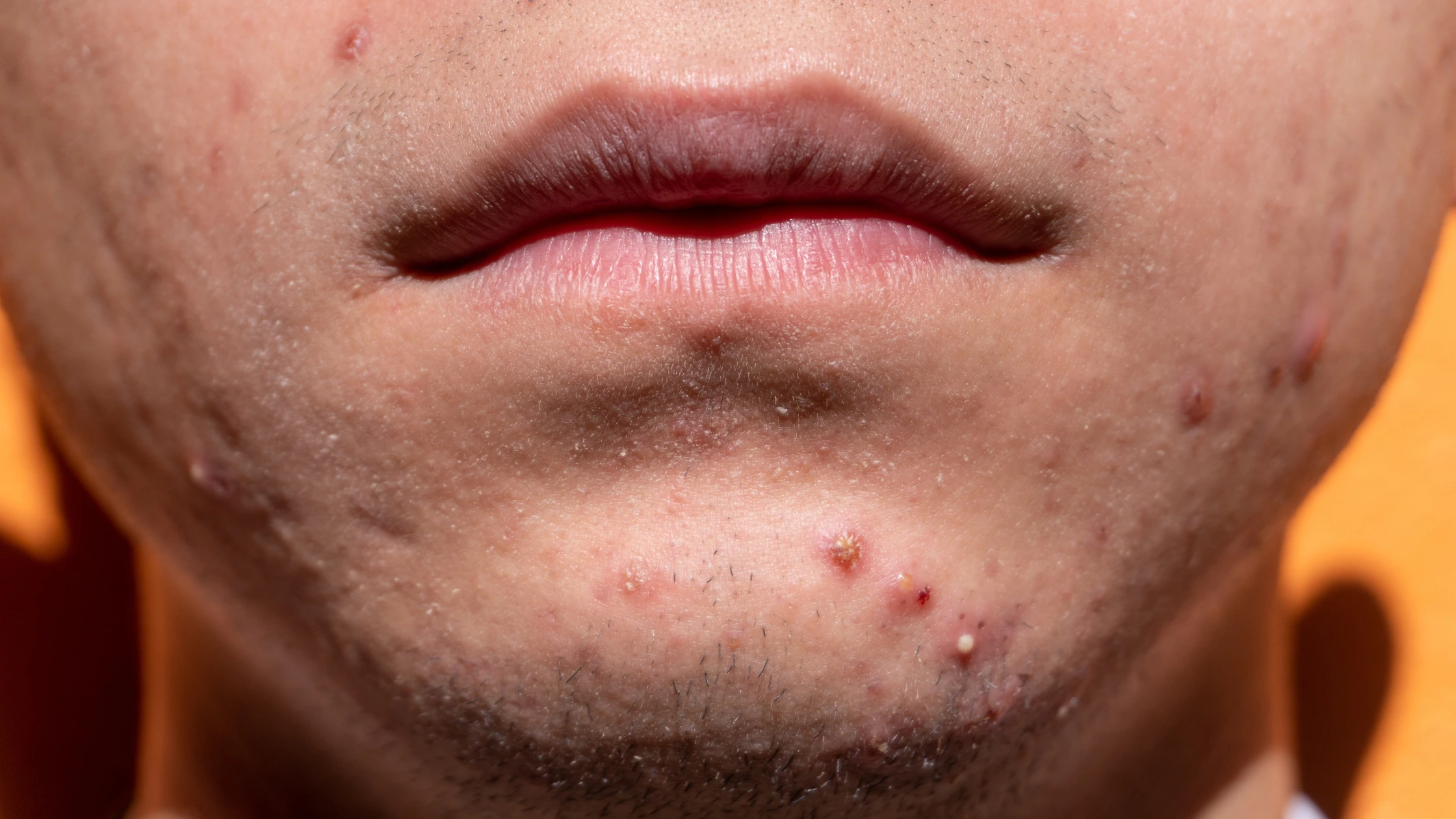 Acne around mouth